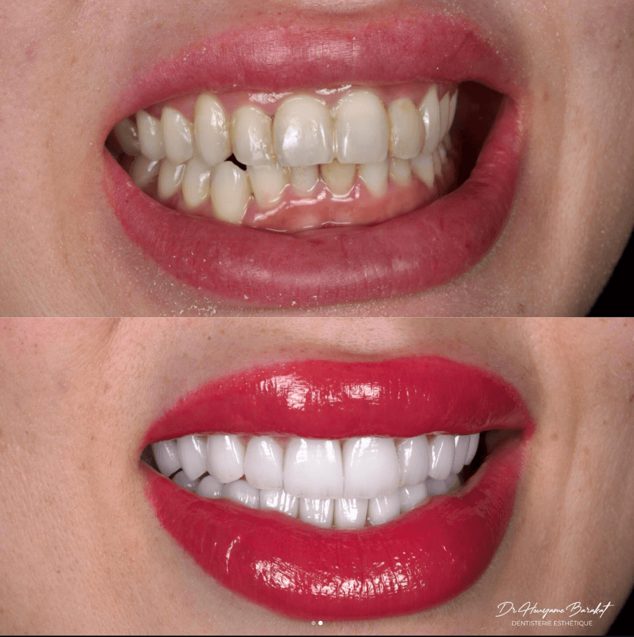 Résultat de dentisterie esthétique au HB Dental Center