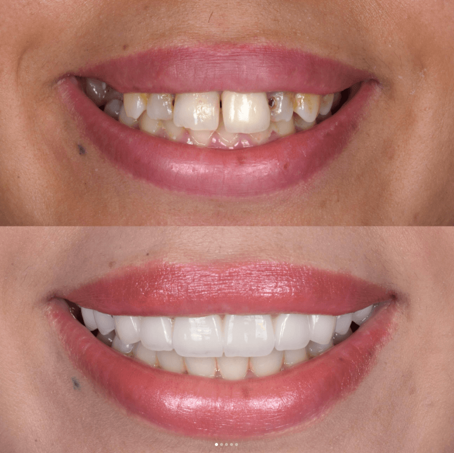 Résultat de facettes dentaires au HB Dental Center