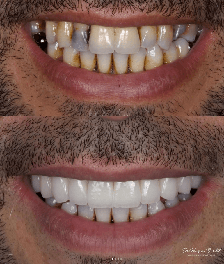 Réhabilitation esthétique du sourire — résultat clinique