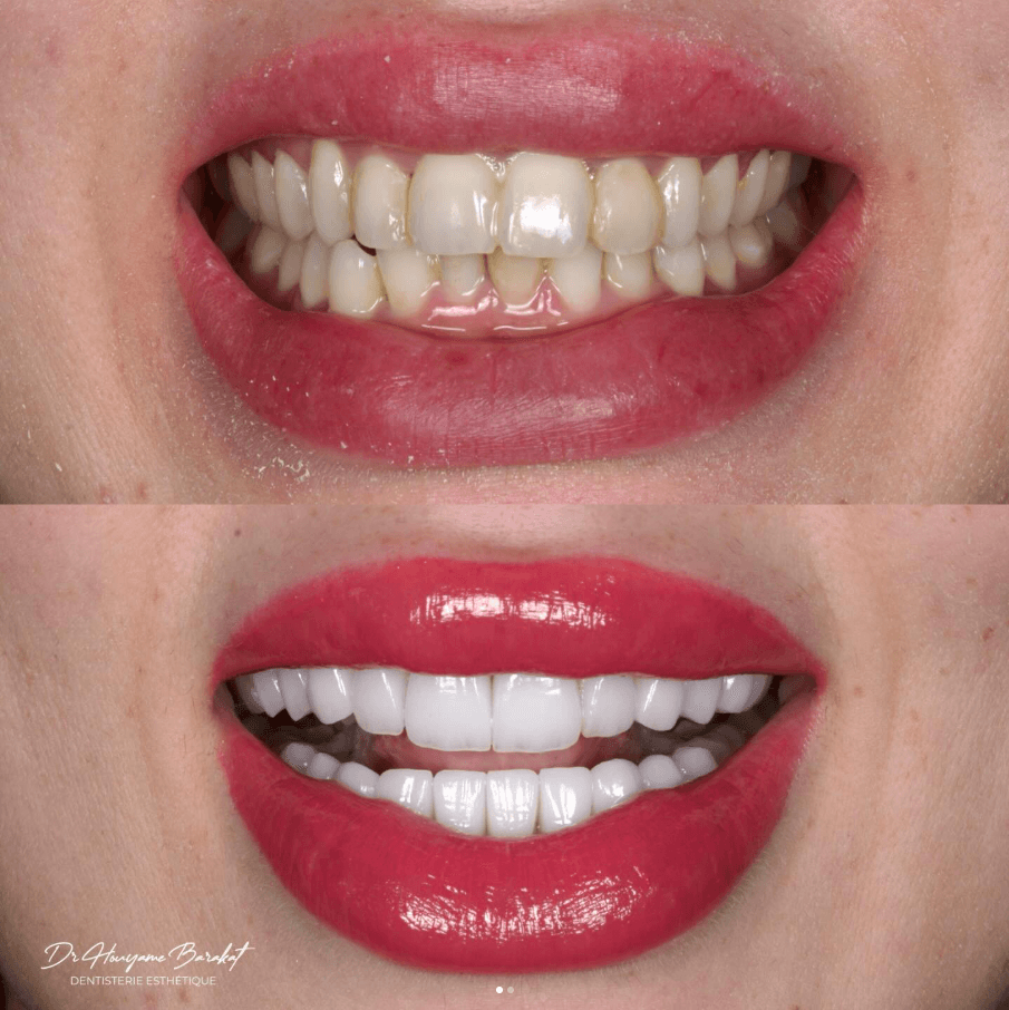 Sourire lumineux après un traitement esthétique au HB Dental Center